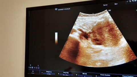 Lanzan iniciativa multimillonaria para la prevención de la muerte fetal intrauterina