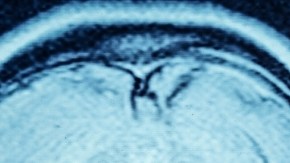 Cerebro de los hombres se encoge más rápido que el de las mujeres, revela un estudio