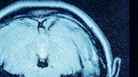 Cerebro de los hombres se encoge más rápido que el de las mujeres, revela un estudio