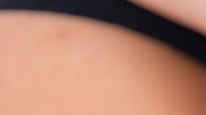 ¿Qué riesgos corres tras una mordida de animal?