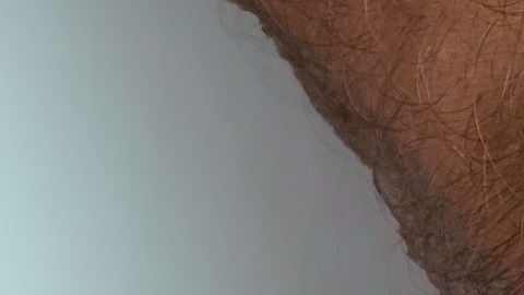 Brote de sarampión en centro de detención de ICE.