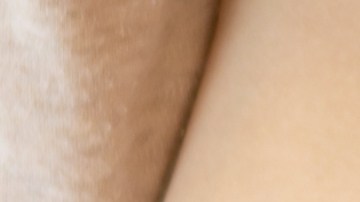 La cesárea es una intervención quirúrgica mayor: no debe subestimarse y requiere cuidados especiales para su correcta cicatrización.