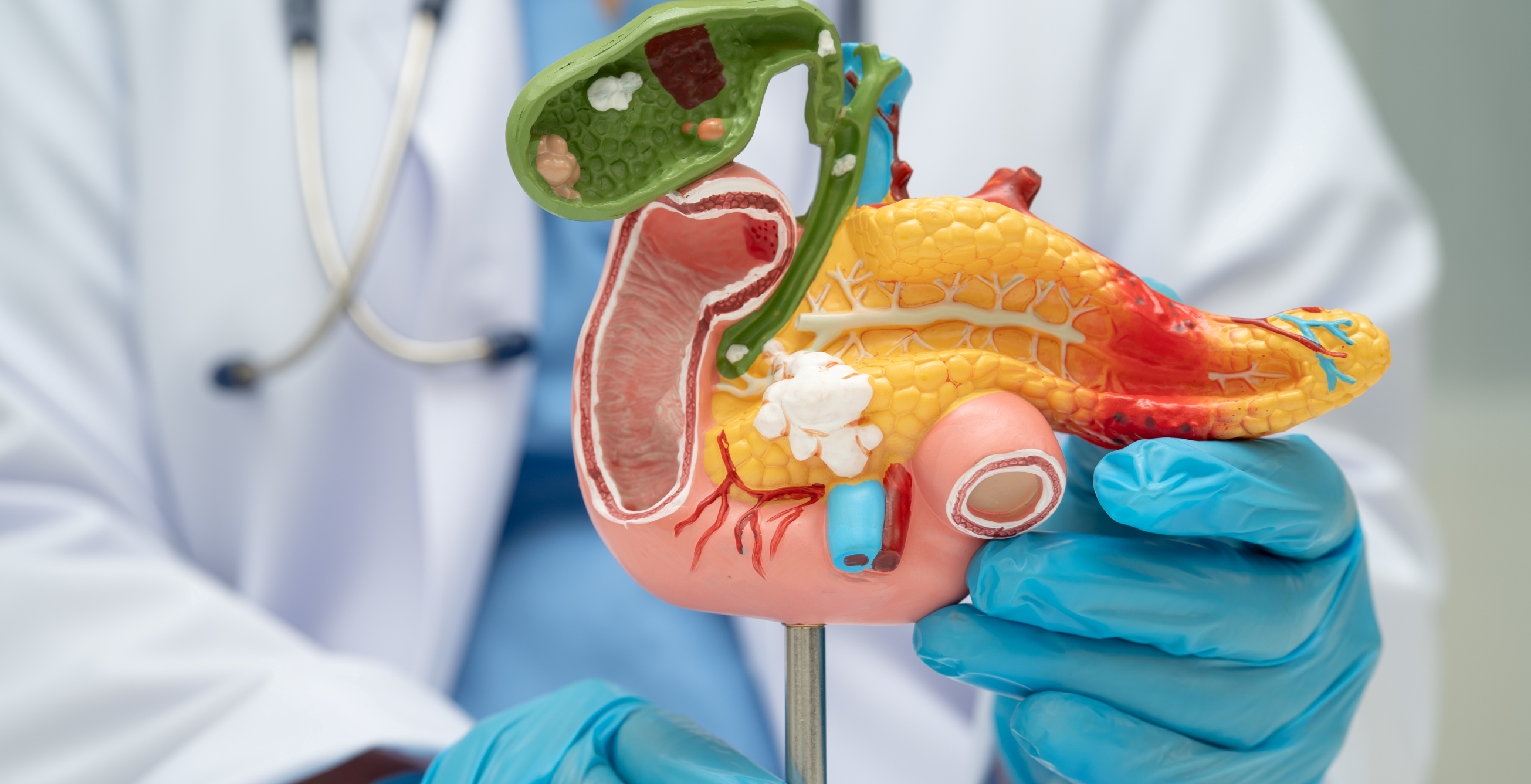 Aceleran píldora experimental que promete una nueva esperanza para el cáncer de páncreas mortal