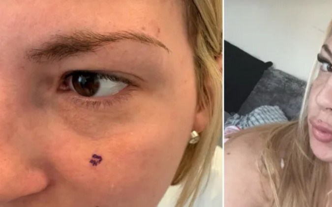 La aparición de un grano inusual en el rostro desembocó en lo peor