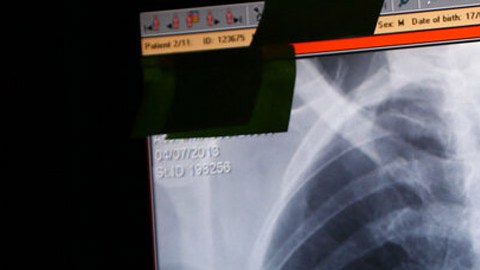 Revisión de pruebas de contagios de tuberculosis