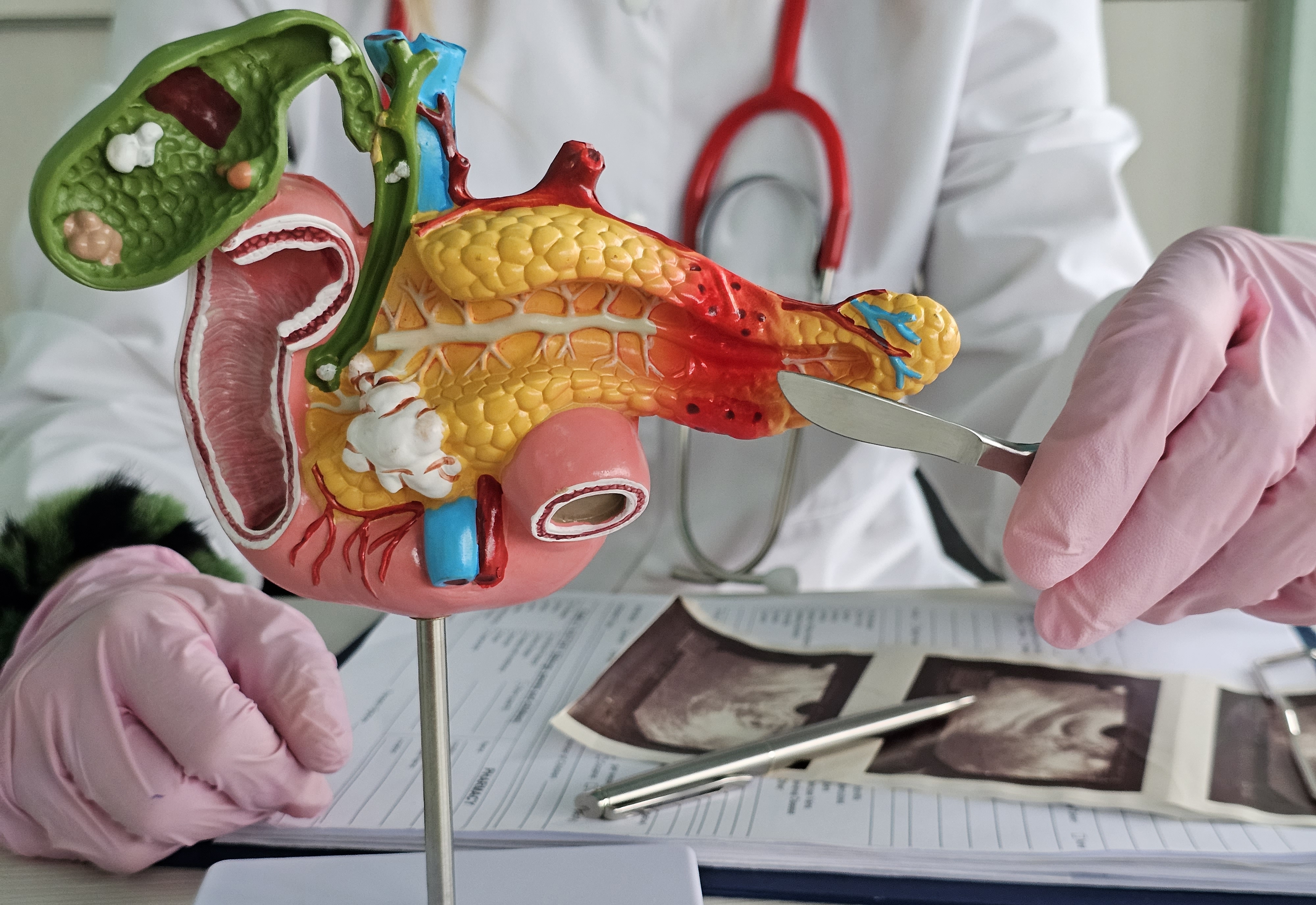 ¿Rasonque puede realmente curar el cáncer de páncreas? Expertos lo aclaran