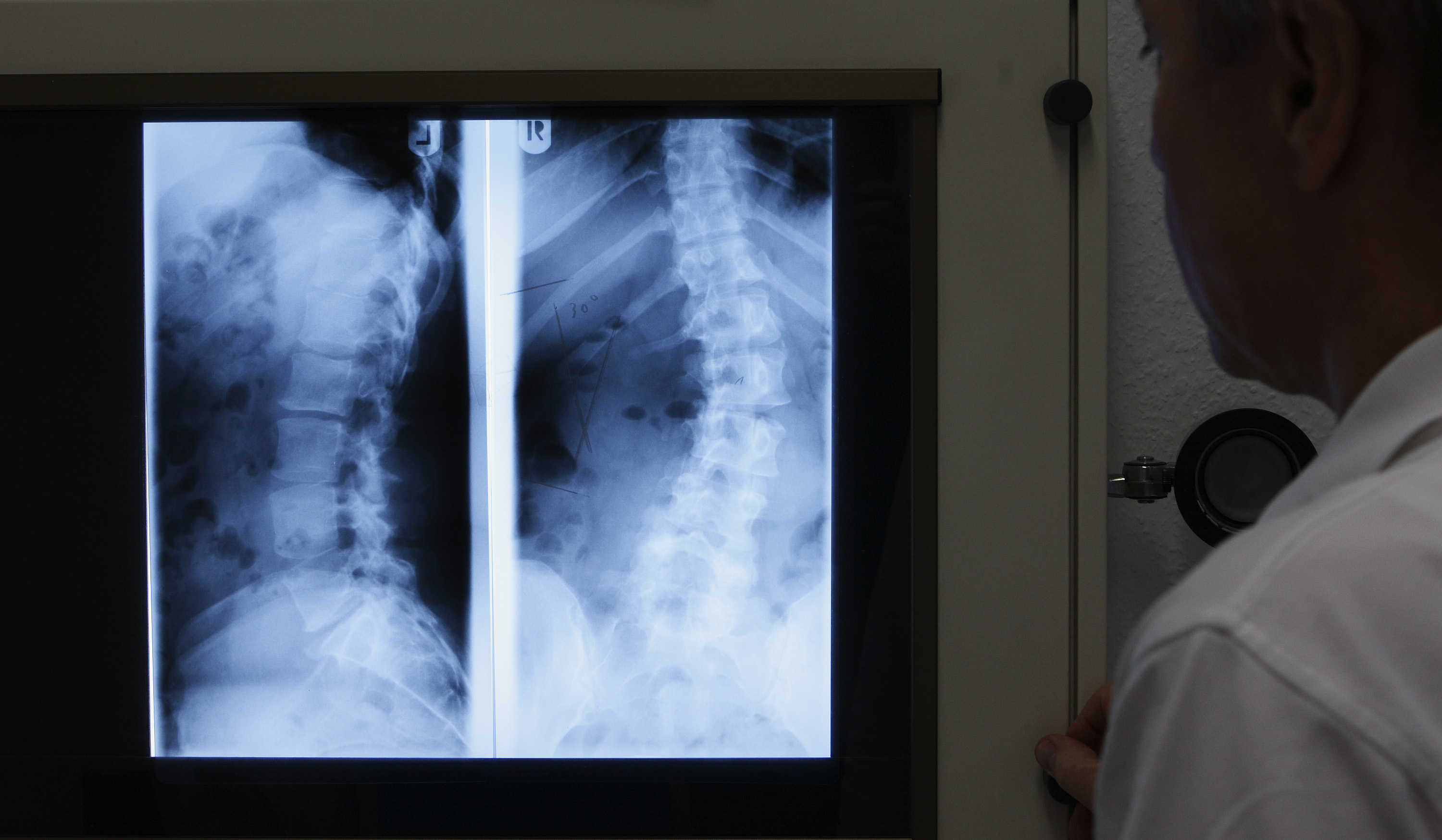 Hispana de 12 años camina tras recuperarse de una lesión medular, en el sur de California