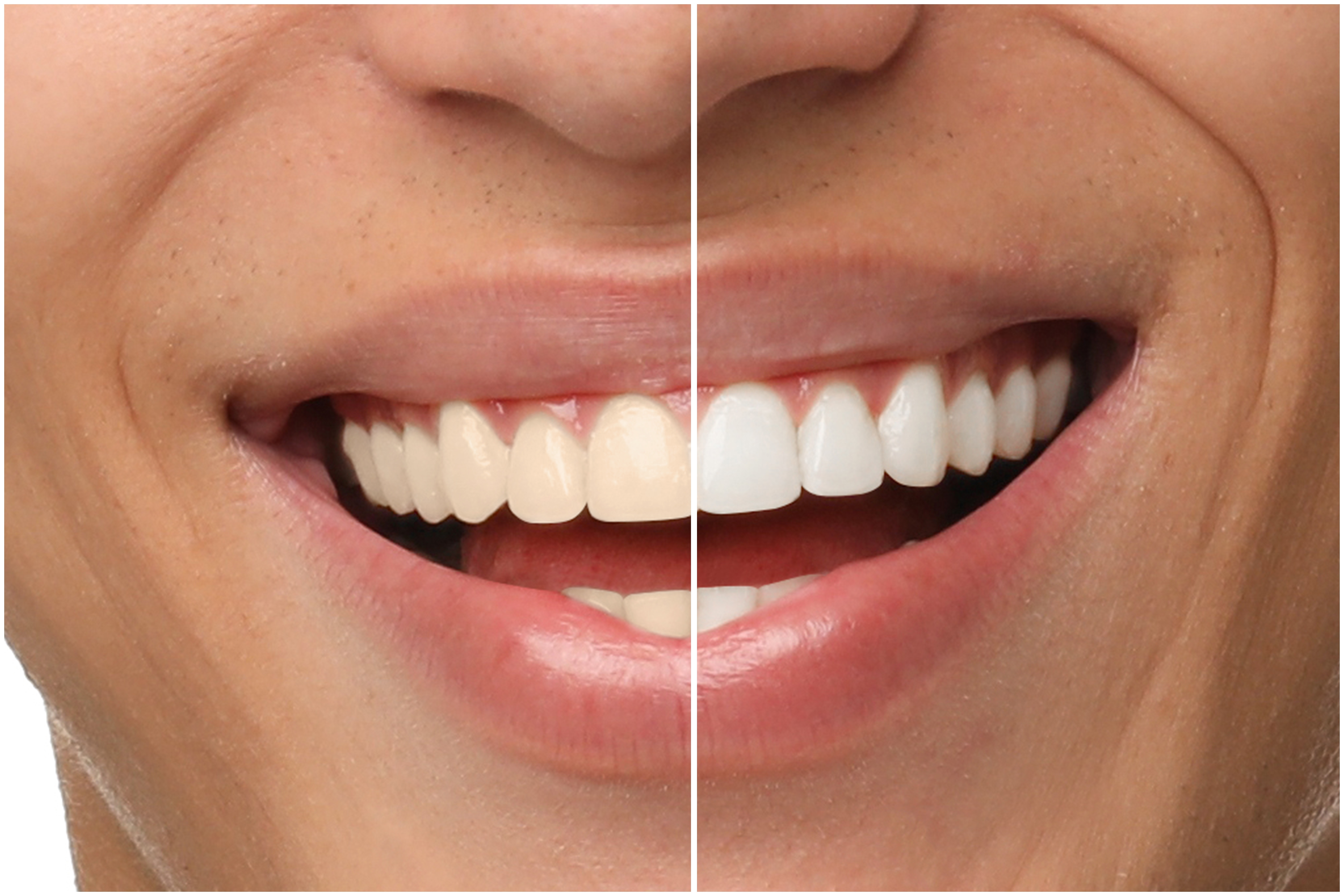 Blanquear tus dientes: 3 riesgos que nadie te cuenta