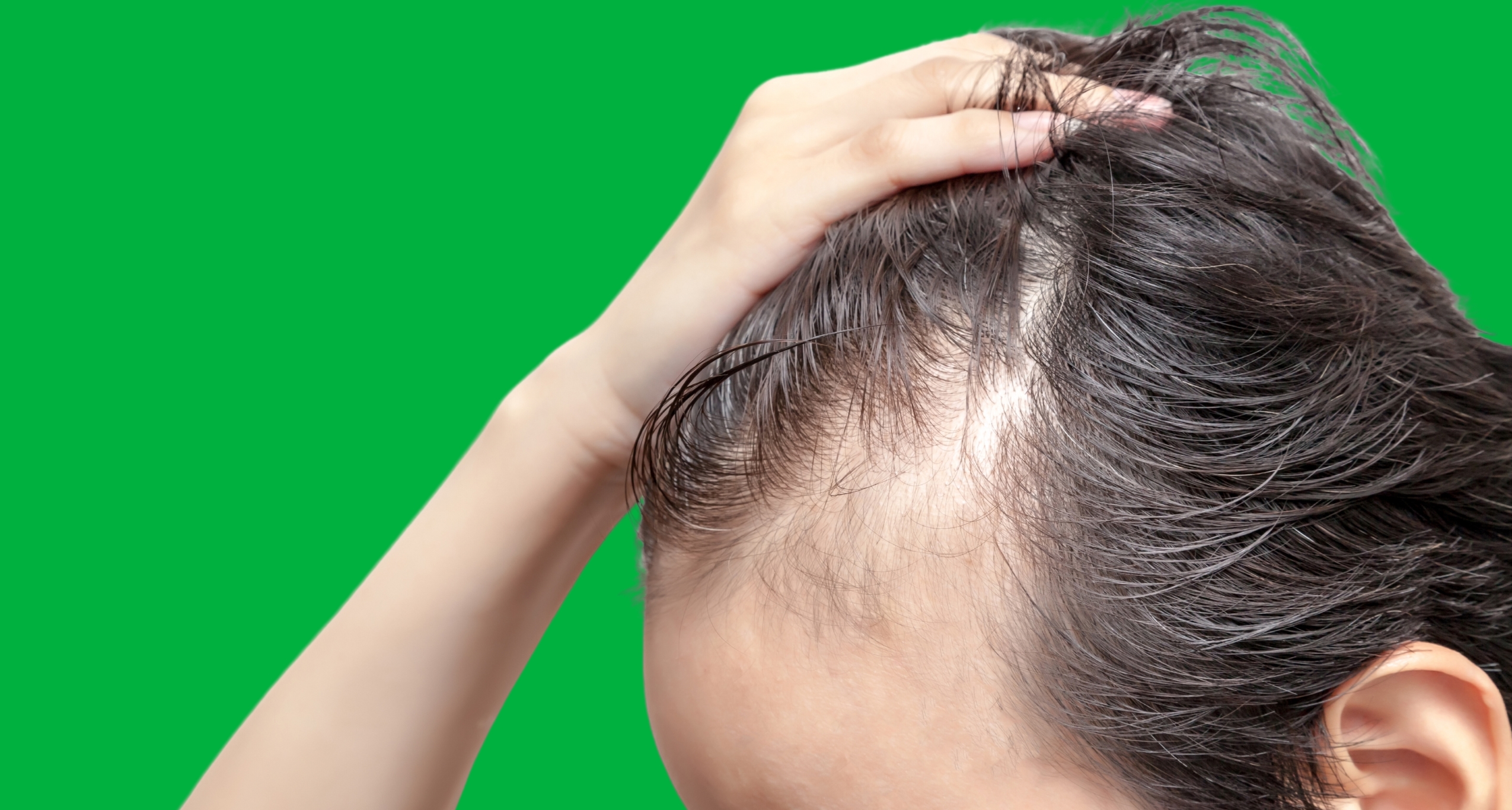 Revelan que medicamentos GLP-1 pueden acelerar la caída del cabello en hombres