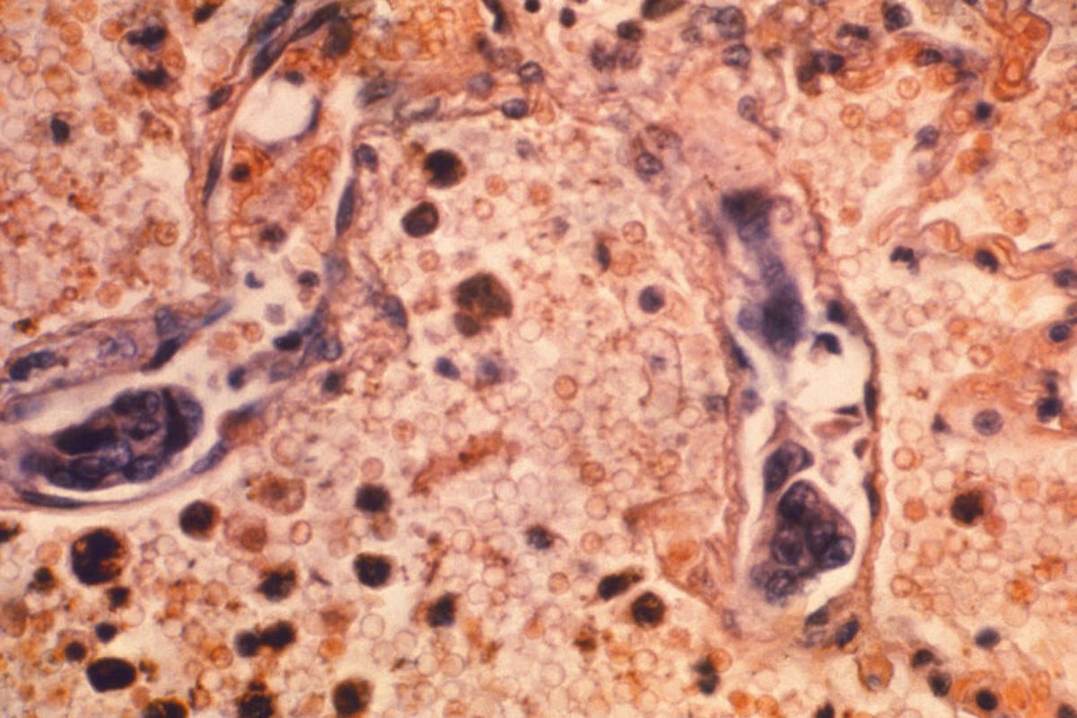 ¿Qué es el adenocarcinoma pulmonar, enemigo silencioso que puso en riesgo la salud del Papa León XVI?