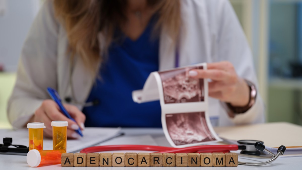 Un número significativo de quienes padecen adenocarcinoma pulmonar no son fumadores, como el papa León XIV