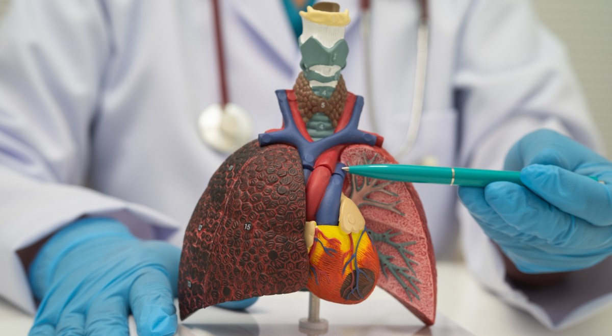Se desarrolla silenciosamente: la detección precoz puede reducir las muertes por cáncer de pulmón